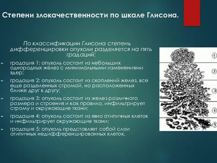 Степени злокачественности по шкале Глисона. По классификации Глисона степень дифференцировки