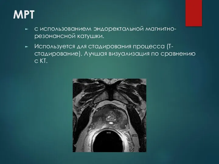 МРТ с использованием эндоректальной магнитно-резонансной катушки. Используется для стадирования процесса