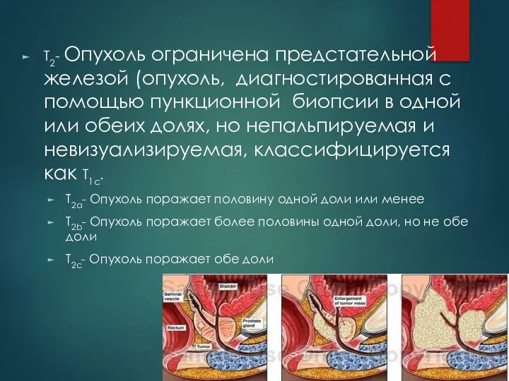 Т2- Опухоль ограничена предстательной железой (опухоль, диагностированная с помощью пункционной