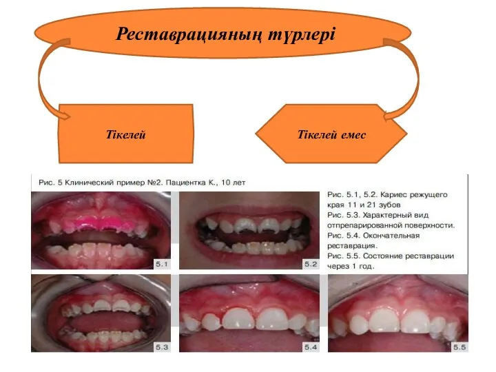 Реставрацияның түрлері Тікелей Тікелей емес