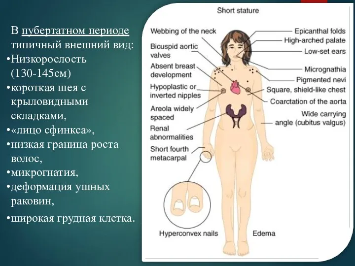 В пубертатном периоде типичный внешний вид: Низкорослость (130-145см) короткая шея