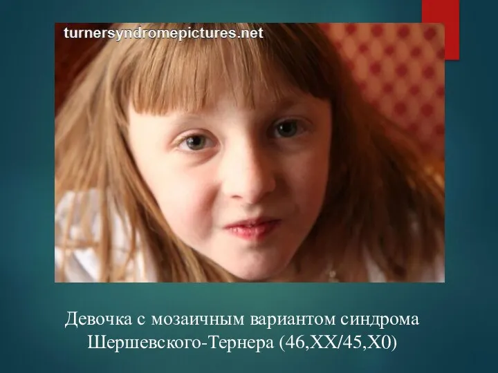Девочка с мозаичным вариантом синдрома Шершевского-Тернера (46,ХХ/45,Х0)