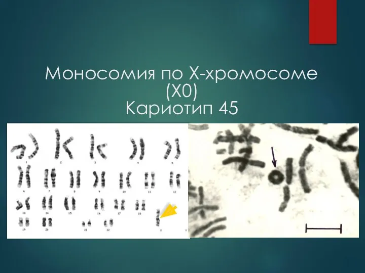 Моносомия по Х-хромосоме (X0) Кариотип 45