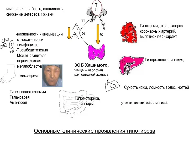 ТЛ ТТ Гипотония, атеросклероз коронарных артерий, выпотной перикардит Гипомоторика, запоры