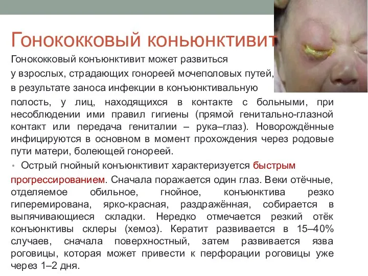 Гонококковый коньюнктивит Гонококковый конъюнктивит может развиться у взрослых, страдающих гонореей мочеполовых путей, в