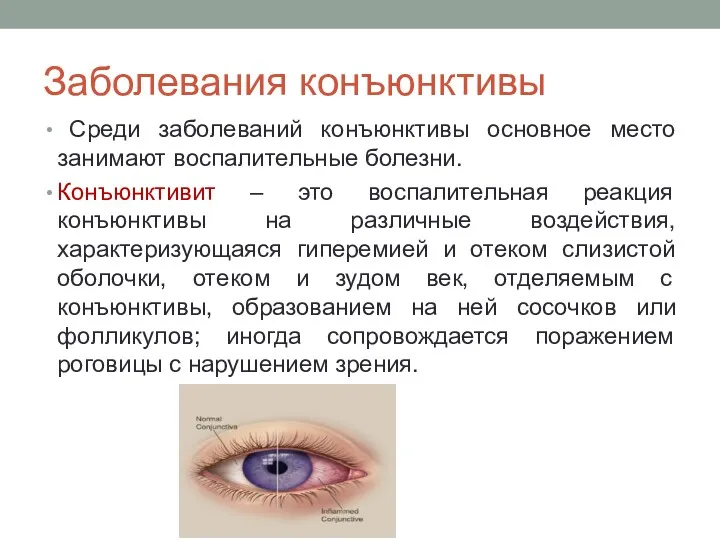 Заболевания конъюнктивы Среди заболеваний конъюнктивы основное место занимают воспалительные болезни. Конъюнктивит – это