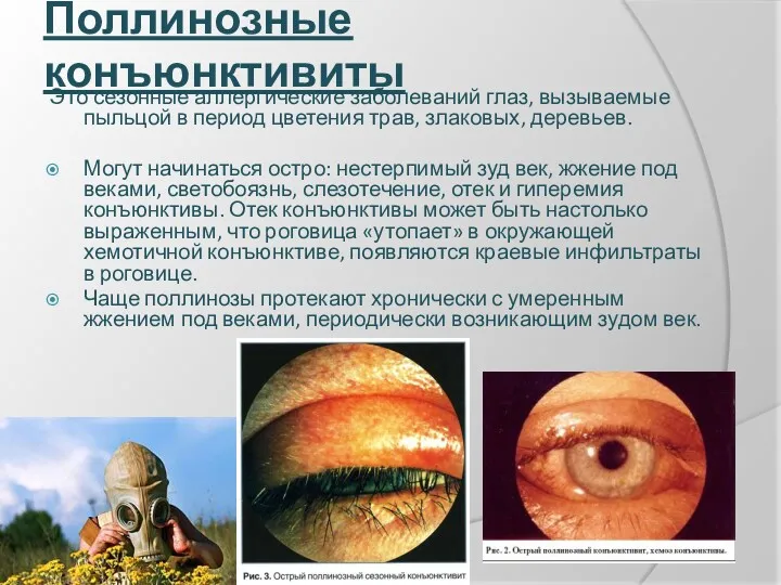 Поллинозные конъюнктивиты Это сезонные аллергические заболеваний глаз, вызываемые пыльцой в период цветения трав,