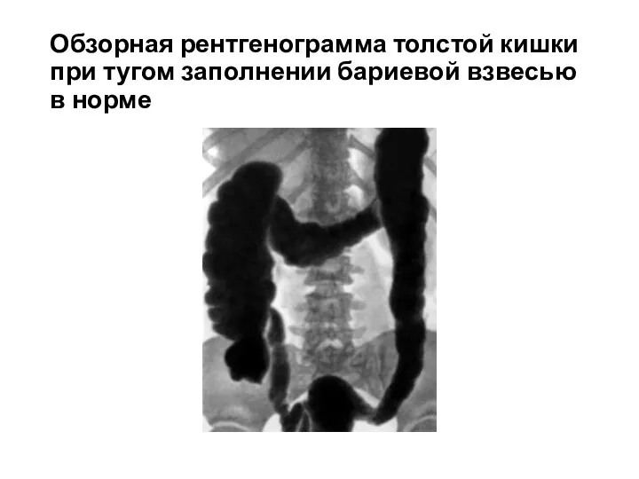 Обзорная рентгенограмма толстой кишки при тугом заполнении бариевой взвесью в норме