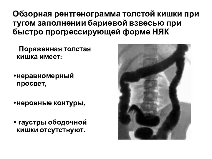 Обзорная рентгенограмма толстой кишки при тугом заполнении бариевой взвесью при