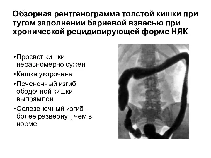 Обзорная рентгенограмма толстой кишки при тугом заполнении бариевой взвесью при