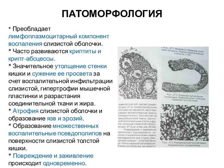 ПАТОМОРФОЛОГИЯ * Преобладает лимфоплазмоцитарный компонент воспаления слизистой оболочки. * Часто