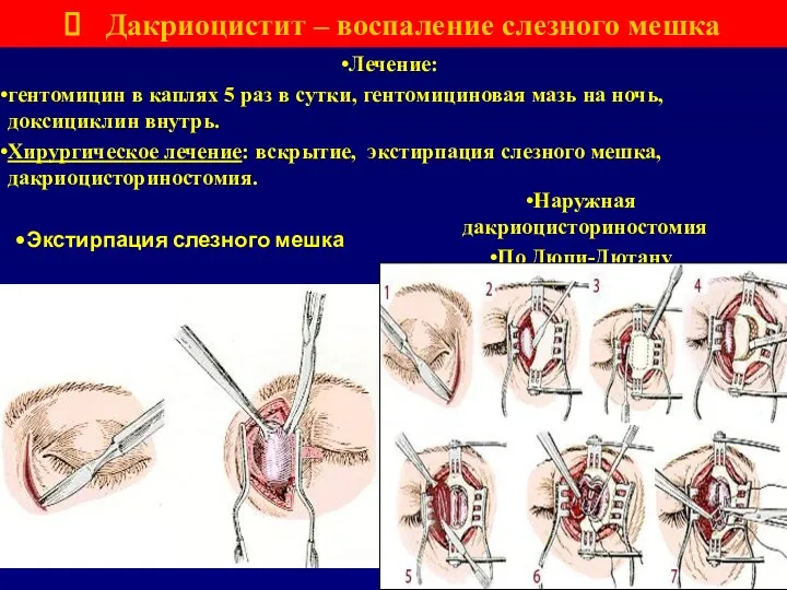 Дакриоцистит – воспаление слезного мешка Лечение: гентомицин в каплях 5