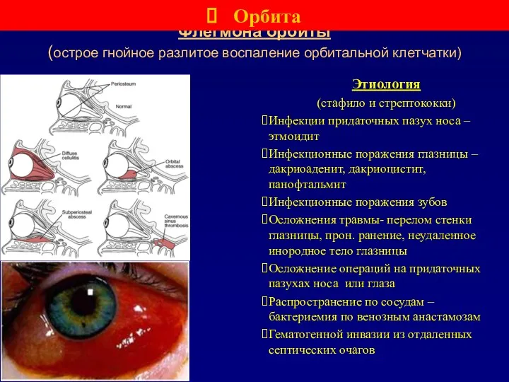 Флегмона орбиты (острое гнойное разлитое воспаление орбитальной клетчатки) Этиология (стафило