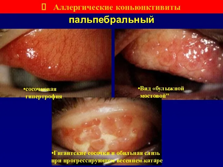 пальпебральный Вид «булыжной мостовой" Гигантские сосочки и обильная слизь при