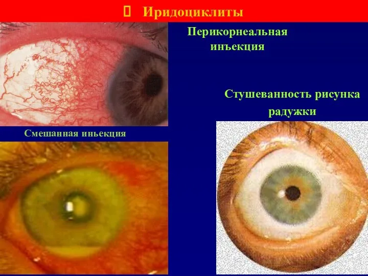 Перикорнеальная инъекция Иридоциклиты Стушеванность рисунка радужки Смешанная иньекция