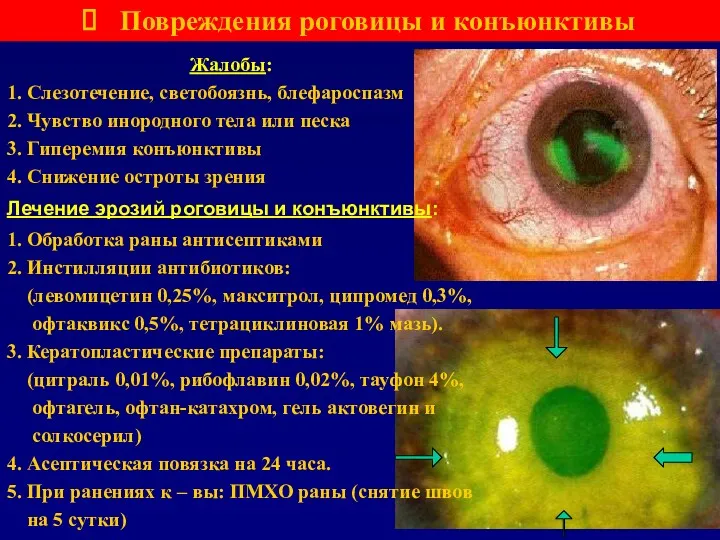 Повреждения роговицы и конъюнктивы Лечение эрозий роговицы и конъюнктивы: 1.