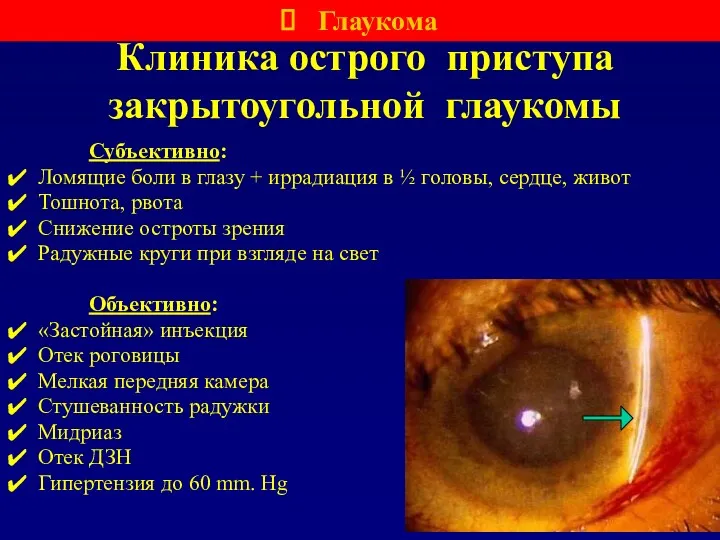 Клиника острого приступа закрытоугольной глаукомы Субъективно: Ломящие боли в глазу