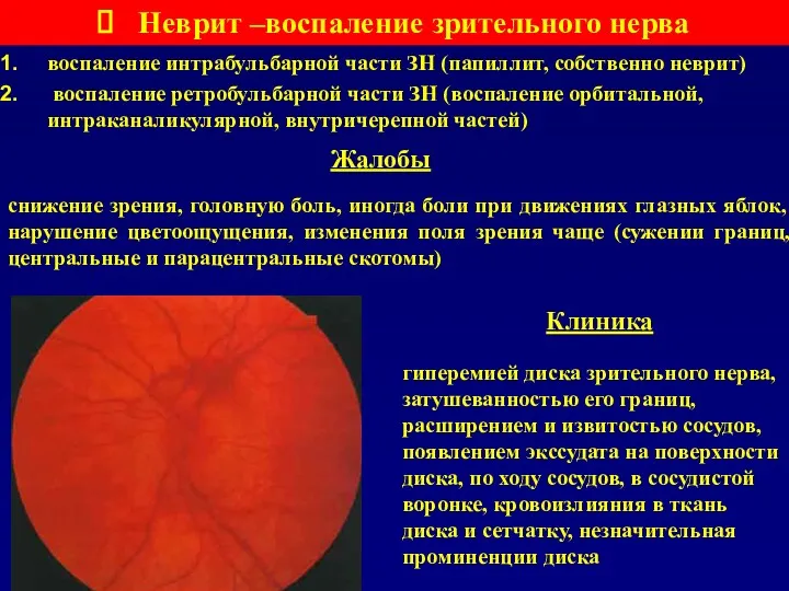 Неврит –воспаление зрительного нерва воспаление интрабульбарной части ЗН (папиллит, собственно