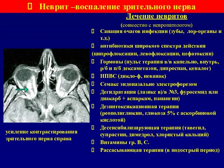 Лечение невритов (совместно с невропатологом) Неврит –воспаление зрительного нерва Санация