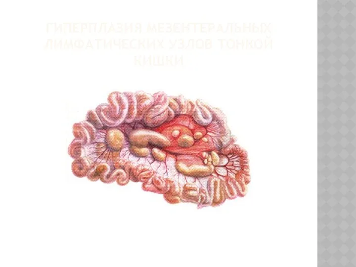 ГИПЕРПЛАЗИЯ МЕЗЕНТЕРАЛЬНЫХ ЛИМФАТИЧЕСКИХ УЗЛОВ ТОНКОЙ КИШКИ