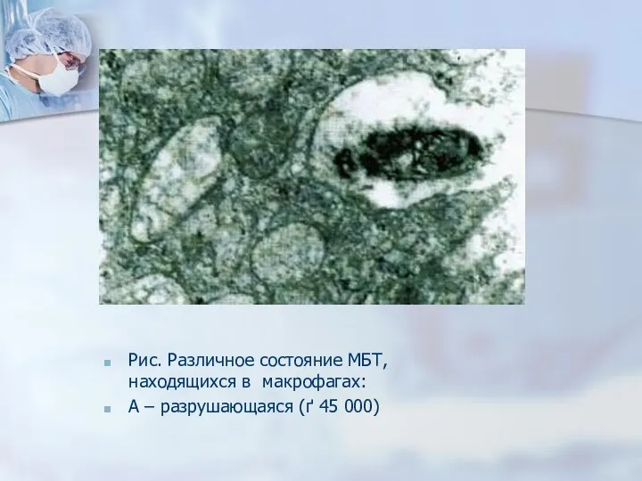 Рис. Различное состояние МБТ, находящихся в макрофагах: А – разрушающаяся (ґ 45 000)