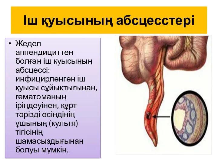 Іш қуысының абсцесстері Жедел аппендициттен болған іш қуысының абсцессі: инфицирленген