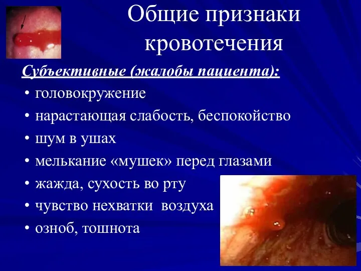 Общие признаки кровотечения Субъективные (жалобы пациента): головокружение нарастающая слабость, беспокойство