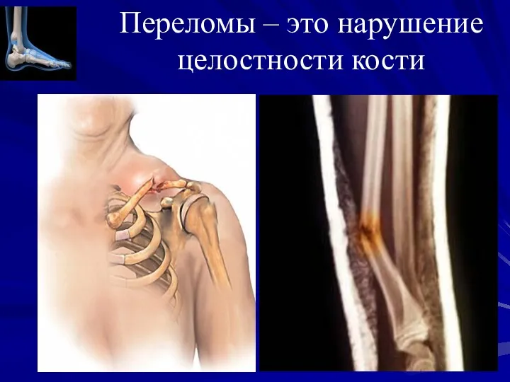 Переломы – это нарушение целостности кости