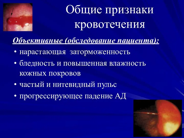 Общие признаки кровотечения Объективные (обследование пациента): нарастающая заторможенность бледность и