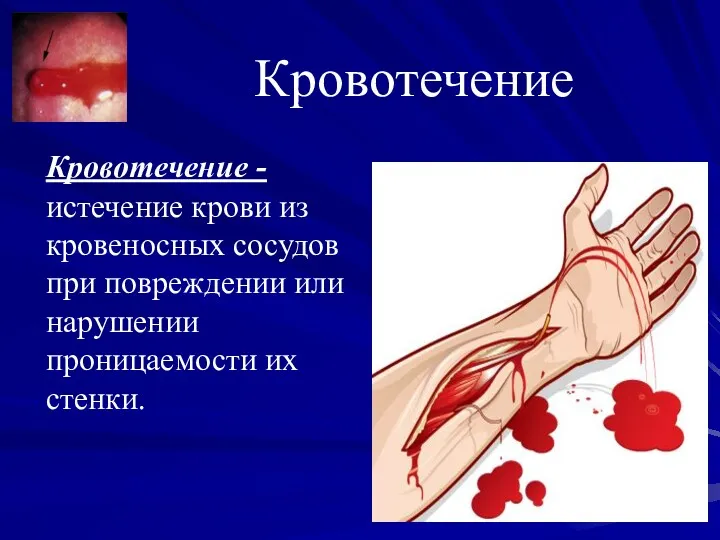Кровотечение - истечение крови из кровеносных сосудов при повреждении или нарушении проницаемости их стенки. Кровотечение