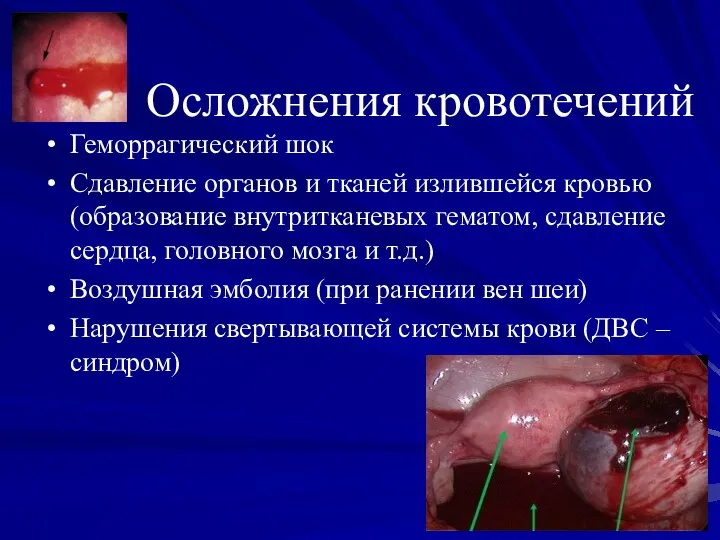 Осложнения кровотечений Геморрагический шок Сдавление органов и тканей излившейся кровью