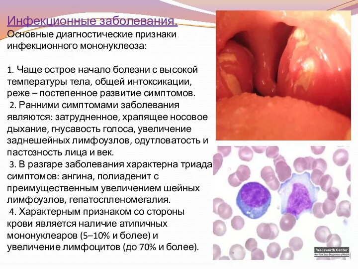 Инфекционные заболевания. Основные диагностические признаки инфекционного мононуклеоза: 1. Чаще острое