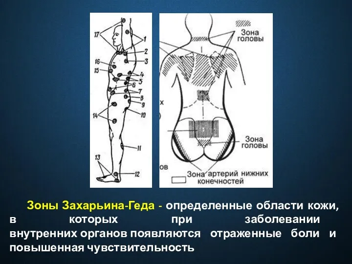 Зоны Захарьина-Геда - определенные области кожи, в которых при заболевании