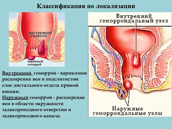 Классификация по локализации Внутренний геморрой - варикозное расширение вен в подслизистом слое дистального