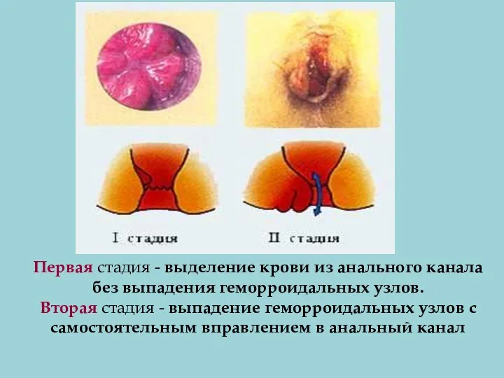 Первая стадия - выделение крови из анального канала без выпадения геморроидальных узлов. Вторая