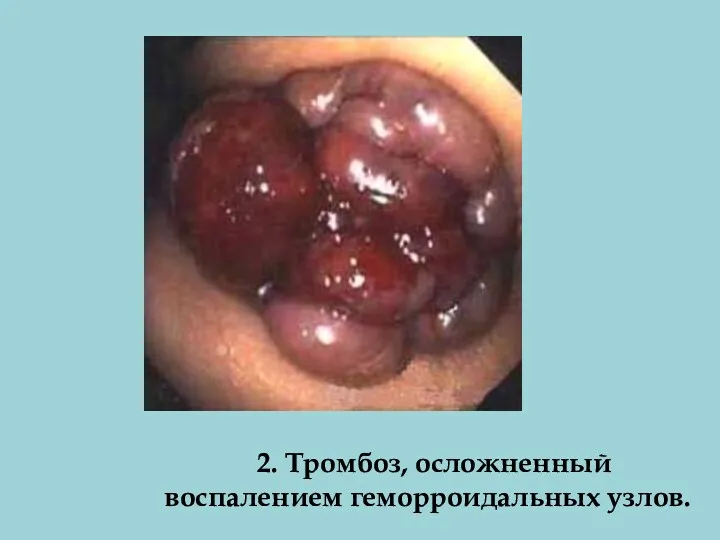 2. Тромбоз, осложненный воспалением геморроидальных узлов.