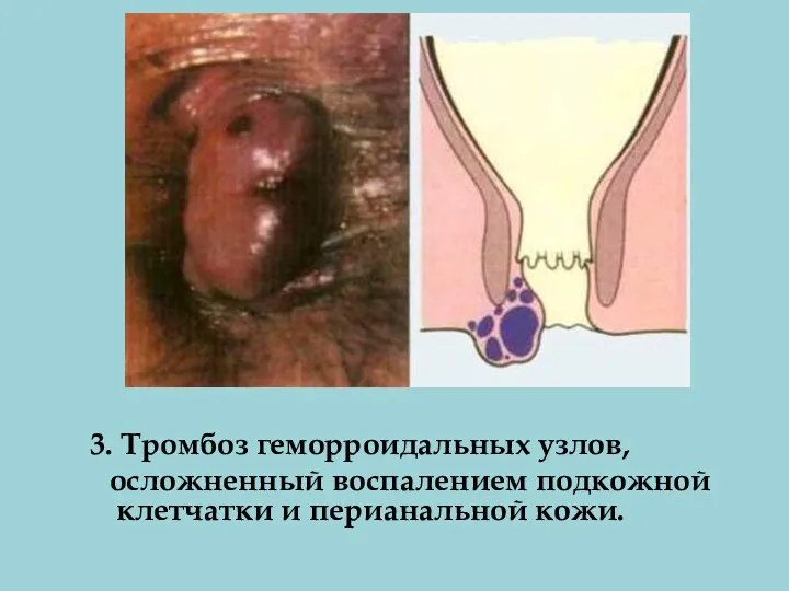 3. Тромбоз геморроидальных узлов, осложненный воспалением подкожной клетчатки и перианальной кожи.