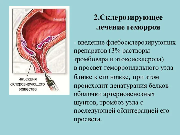 2.Склерозирующее лечение геморроя - введение флебосклерозирующих препаратов (3% растворы тромбовара и этоксисклерола) в