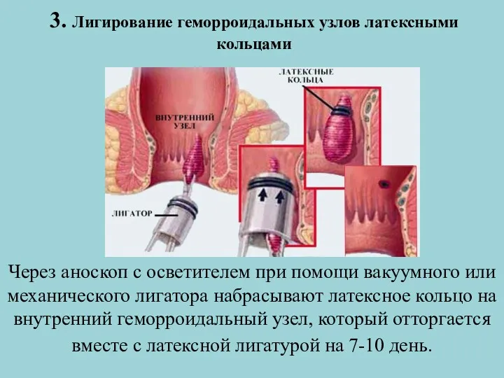 3. Лигирование геморроидальных узлов латексными кольцами Через аноскоп с осветителем при помощи вакуумного