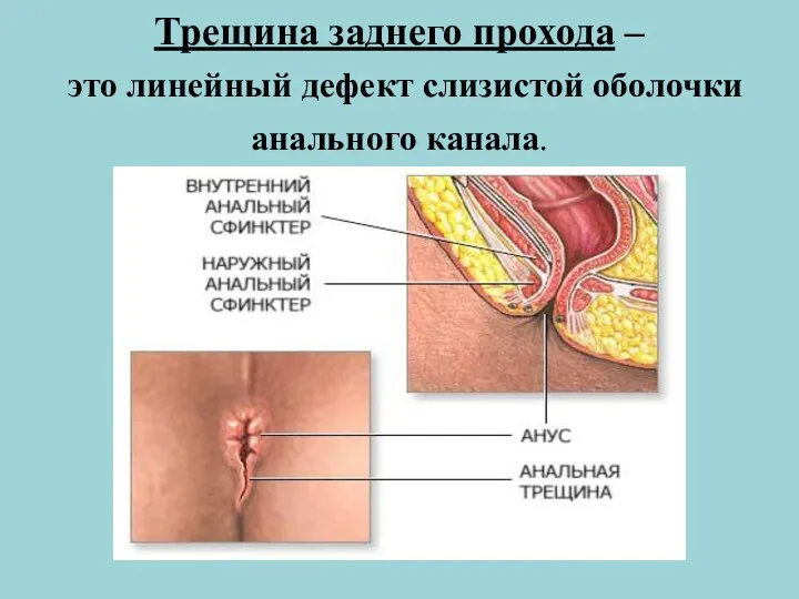 Трещина заднего прохода – это линейный дефект слизистой оболочки анального канала.