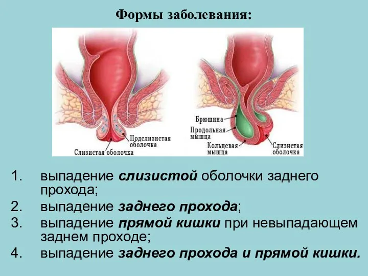 Формы заболевания: выпадение слизистой оболочки заднего прохода; выпадение заднего прохода; выпадение прямой кишки