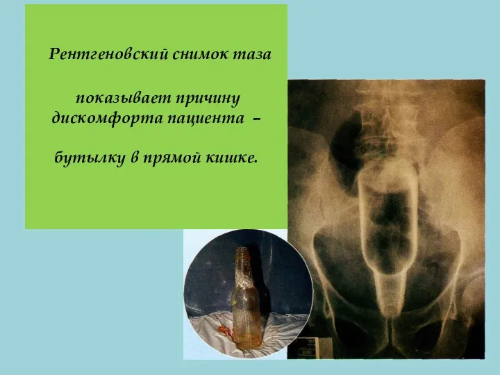 Рентгеновский снимок таза показывает причину дискомфорта пациента – бутылку в прямой кишке.