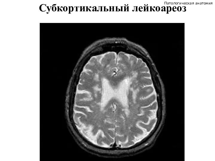 Субкортикальный лейкоареоз Патологическая анатомия