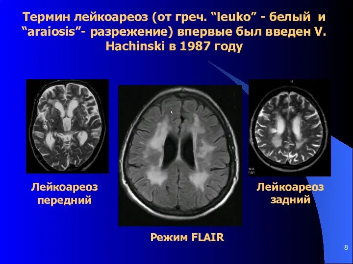 Лейкоареоз передний Лейкоареоз задний Режим FLAIR Термин лейкоареоз (от греч.