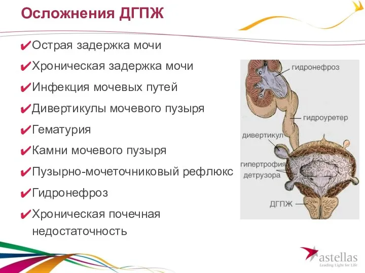 Осложнения ДГПЖ Острая задержка мочи Хроническая задержка мочи Инфекция мочевых