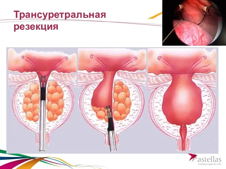 Трансуретральная резекция