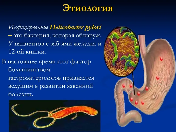 Этиология Инфицирование Helicobacter pylori – это бактерия, которая обнаруж. У пациентов с заб-ями