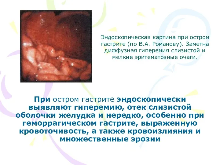 Эндоскопическая картина при остром гастрите (по В.А. Романову). Заметна диффузная гиперемия слизистой и