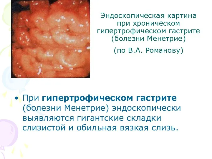 Эндоскопическая картина при хроническом гипертрофическом гастрите (болезни Менетрие) (по В.А. Романову) При гипертрофическом