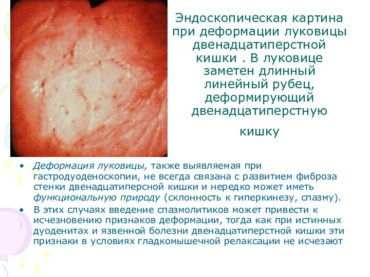 Эндоскопическая картина при деформации луковицы двенадцатиперстной кишки . В луковице заметен длинный линейный